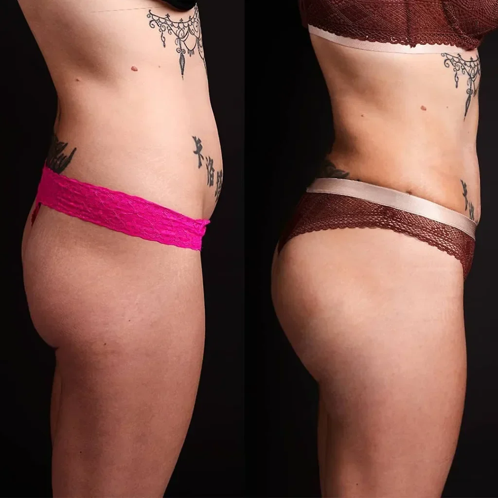 BBL (Brazilian Butt Lift)
