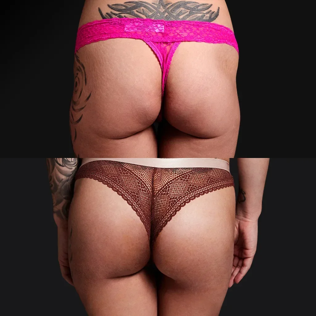 BBL (Brazilian Butt Lift)
