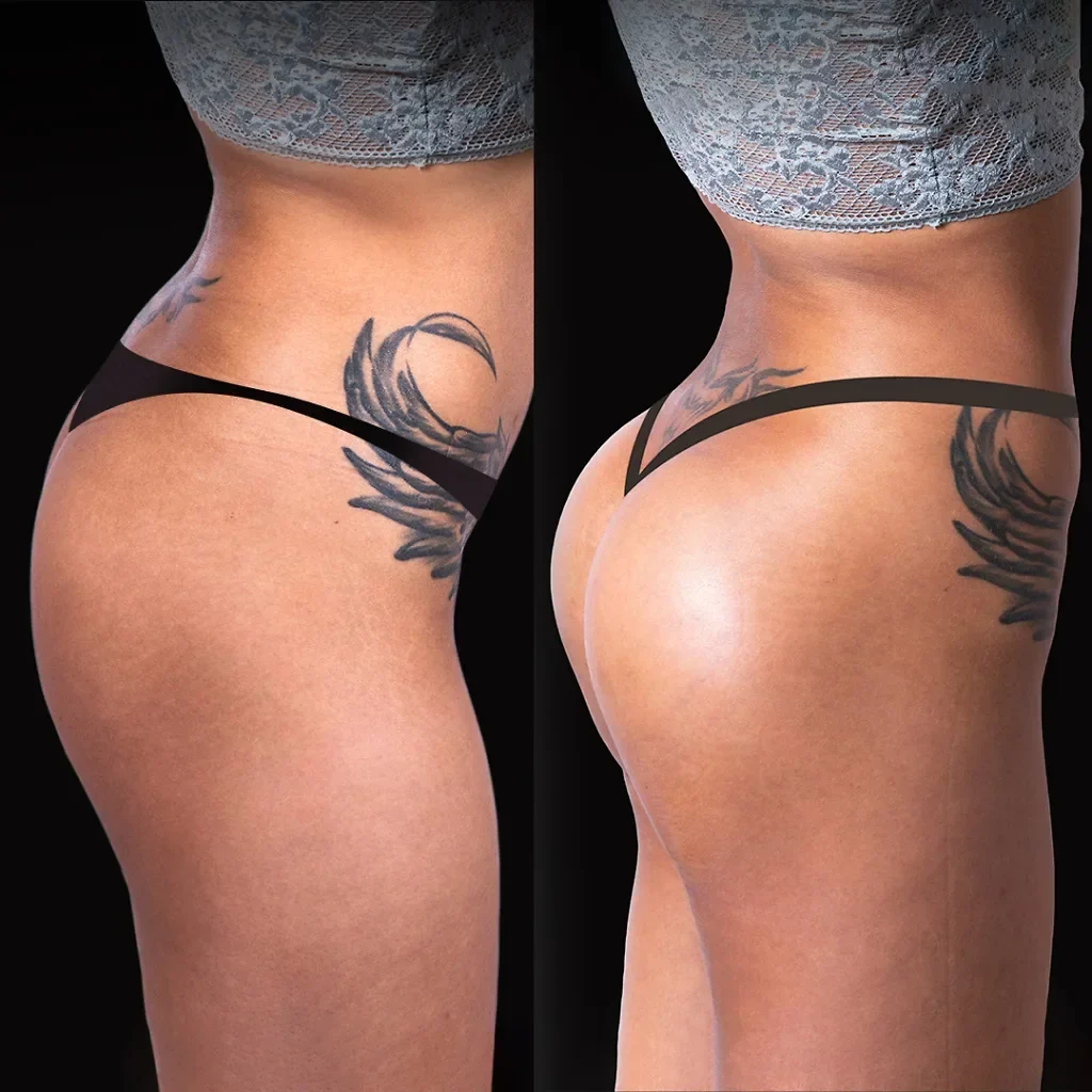 BBL (Brazilian Butt Lift)
