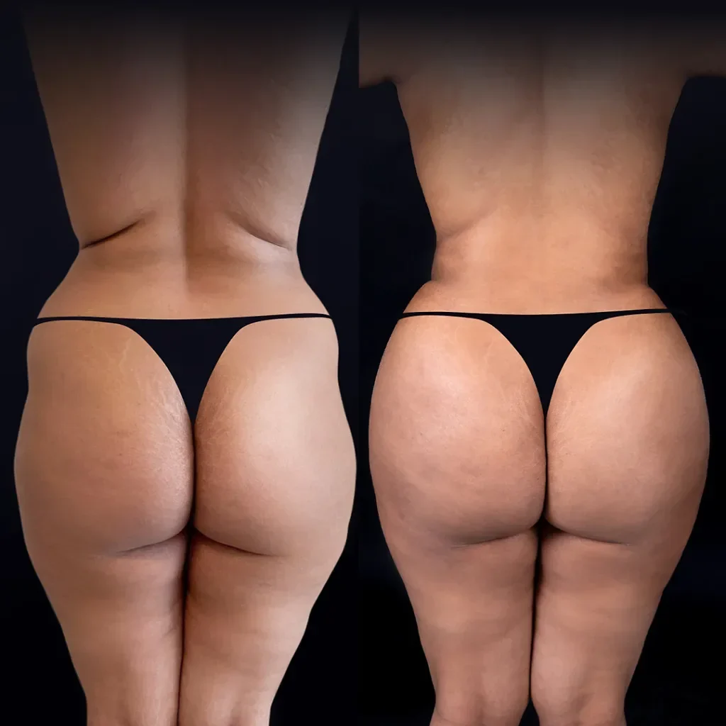 BBL (Brazilian Butt Lift)