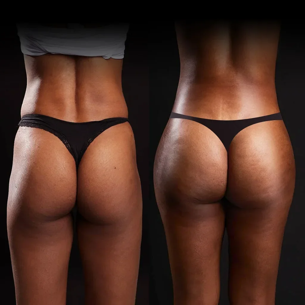 BBL (Brazilian Butt Lift)