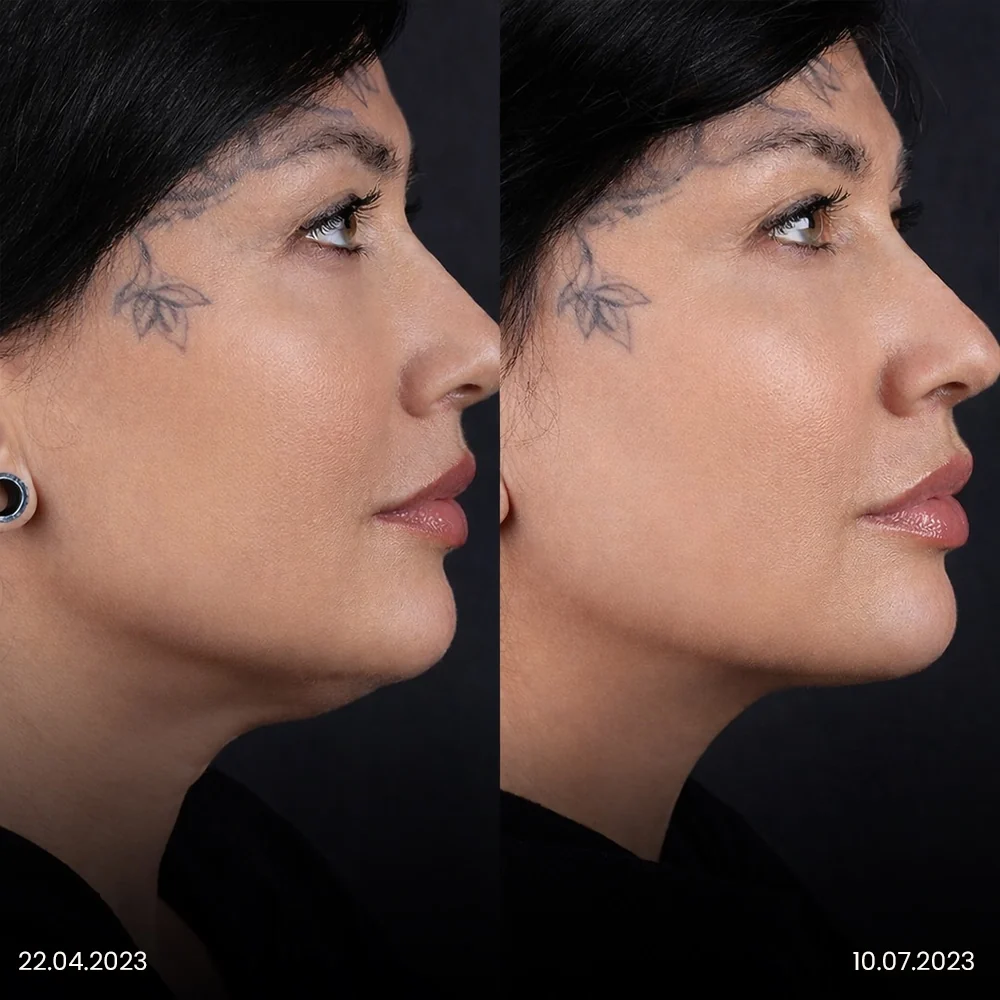 Chin Liposuction