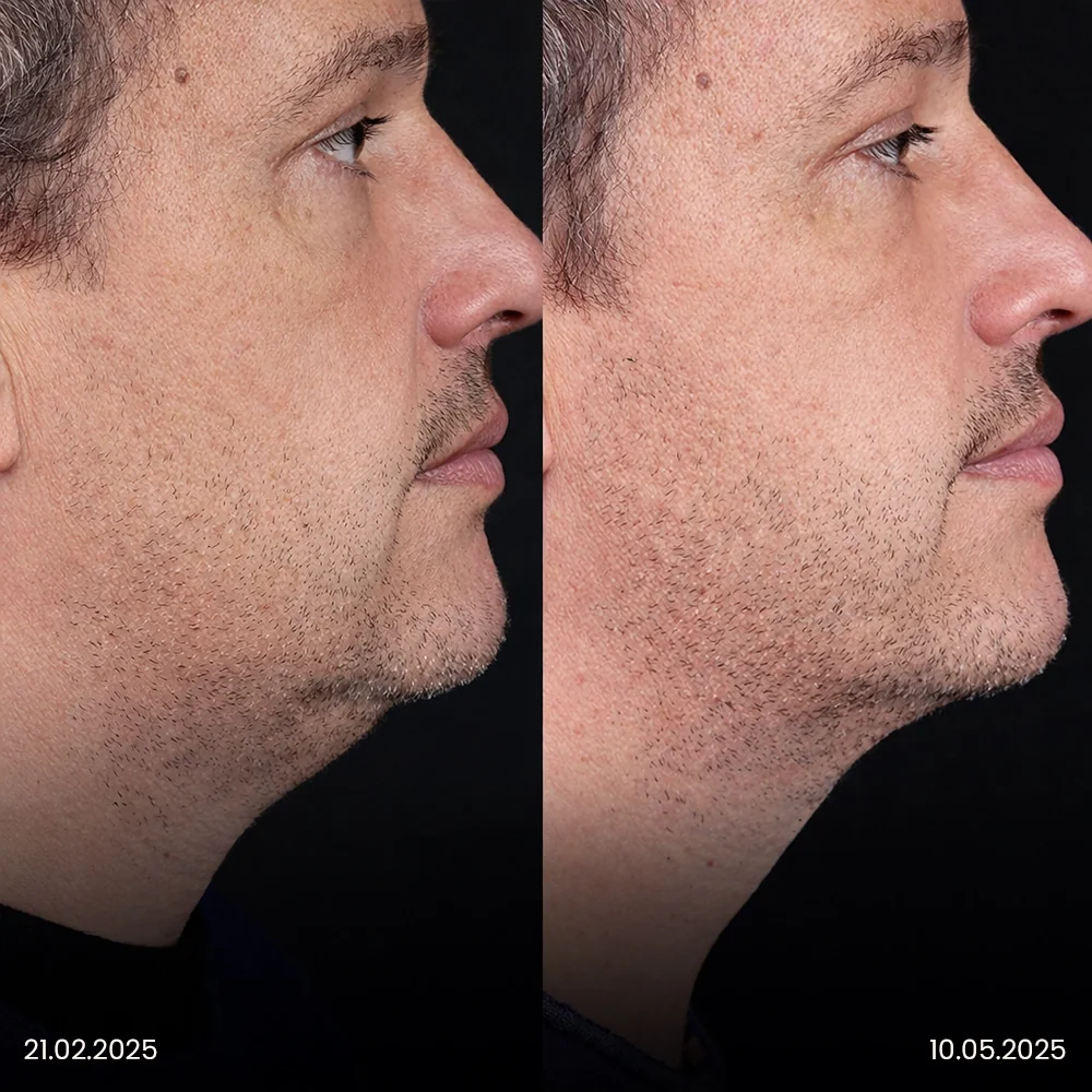 Chin Liposuction