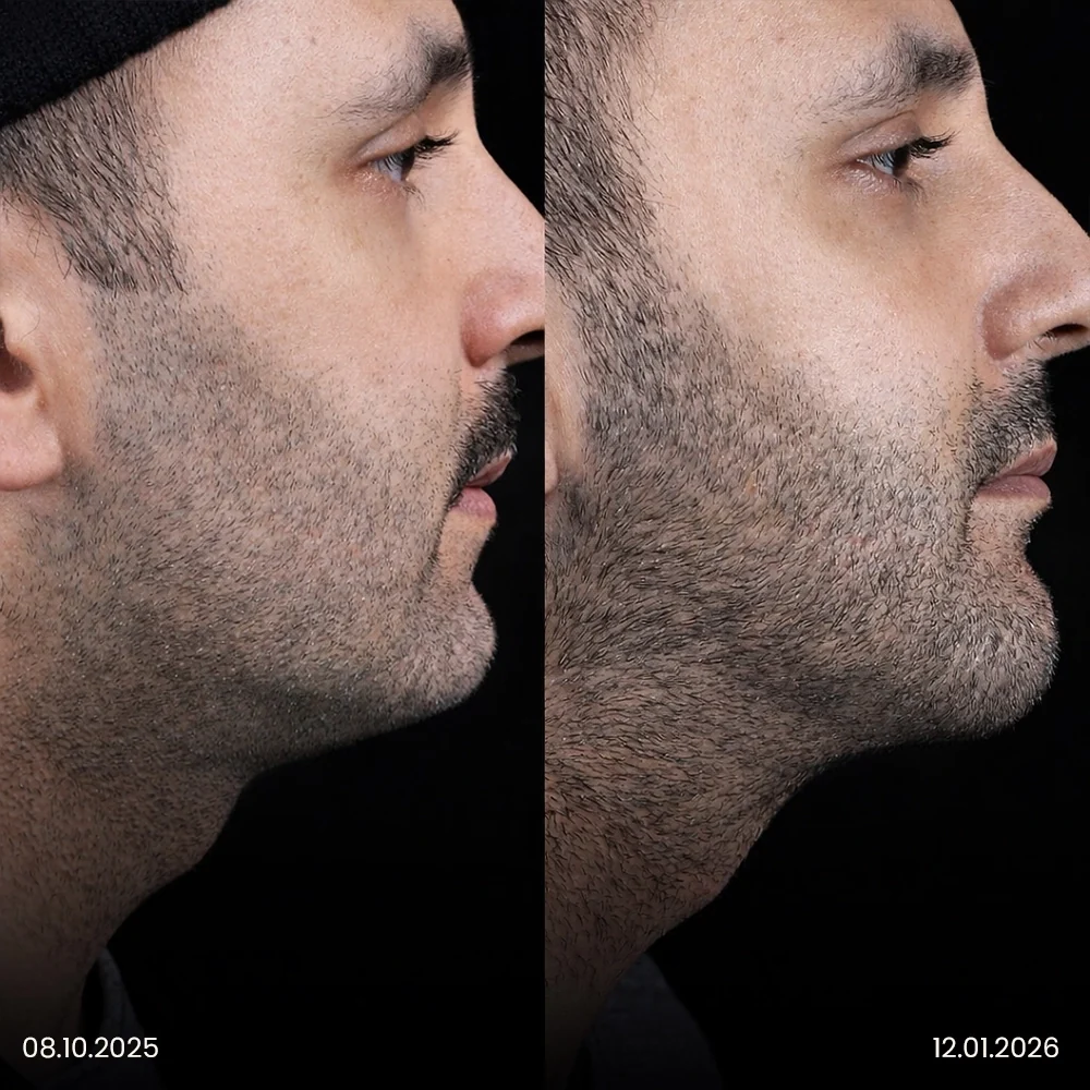 Chin Liposuction