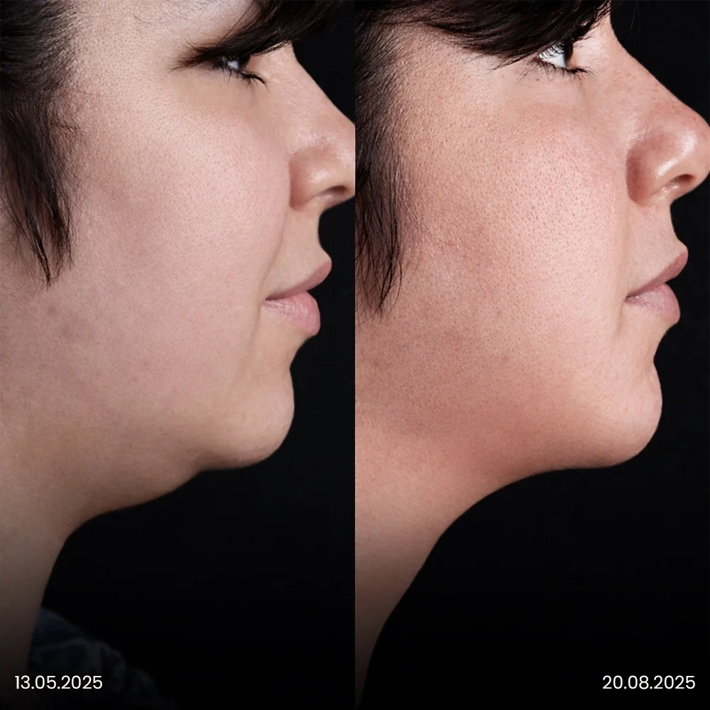 Chin Liposuction