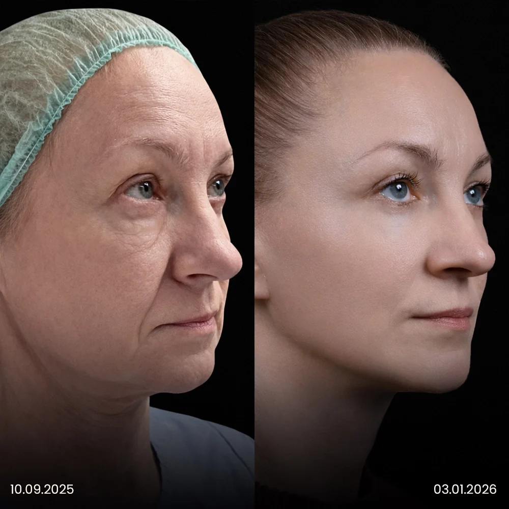 Facelift