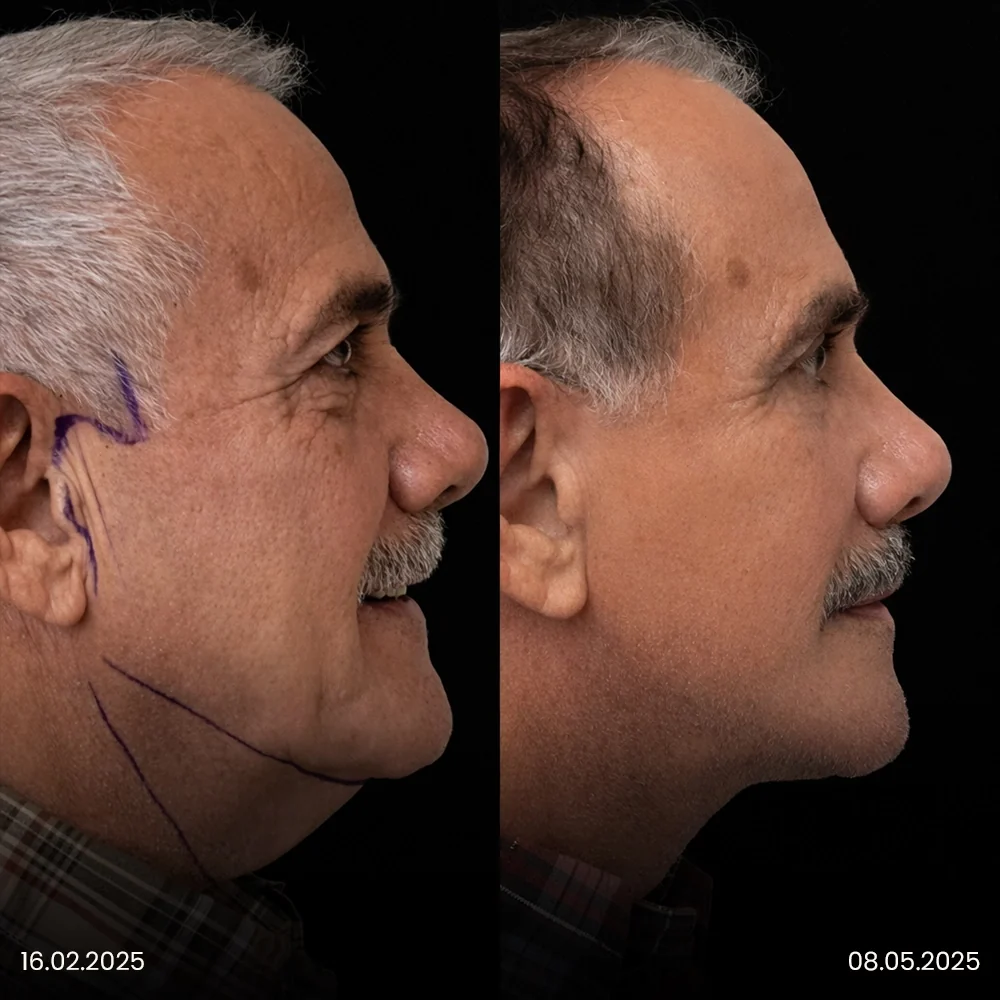 Facelift