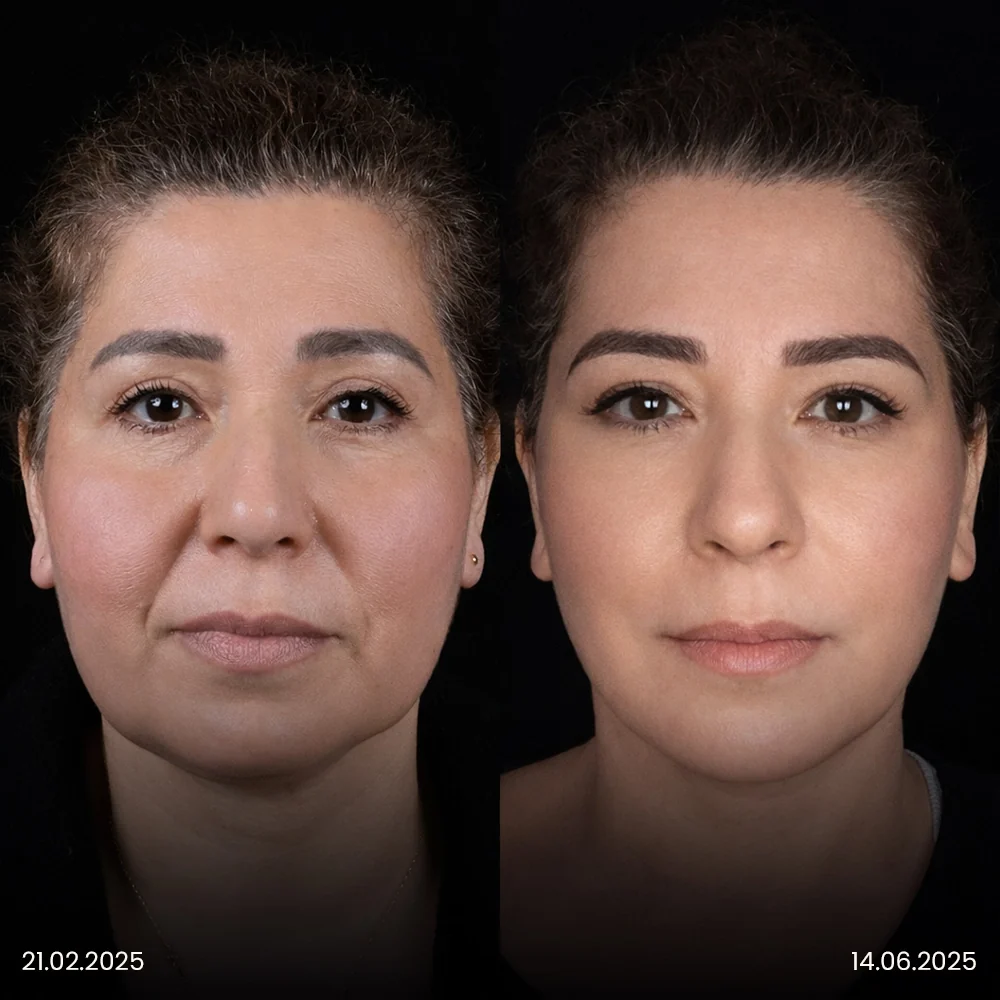 Facelift