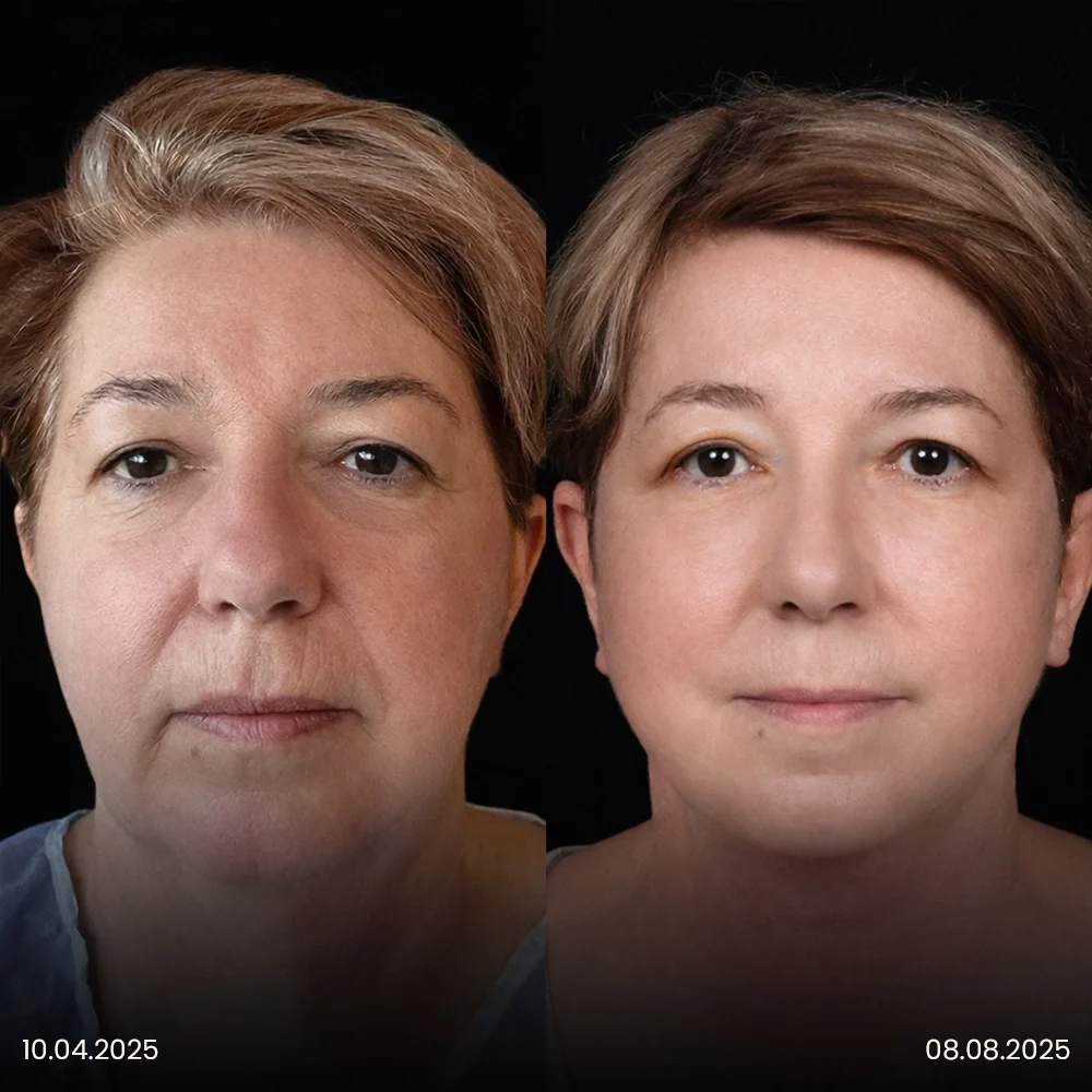 Facelift