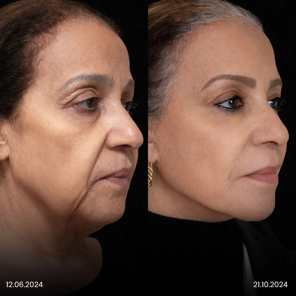 Facelift