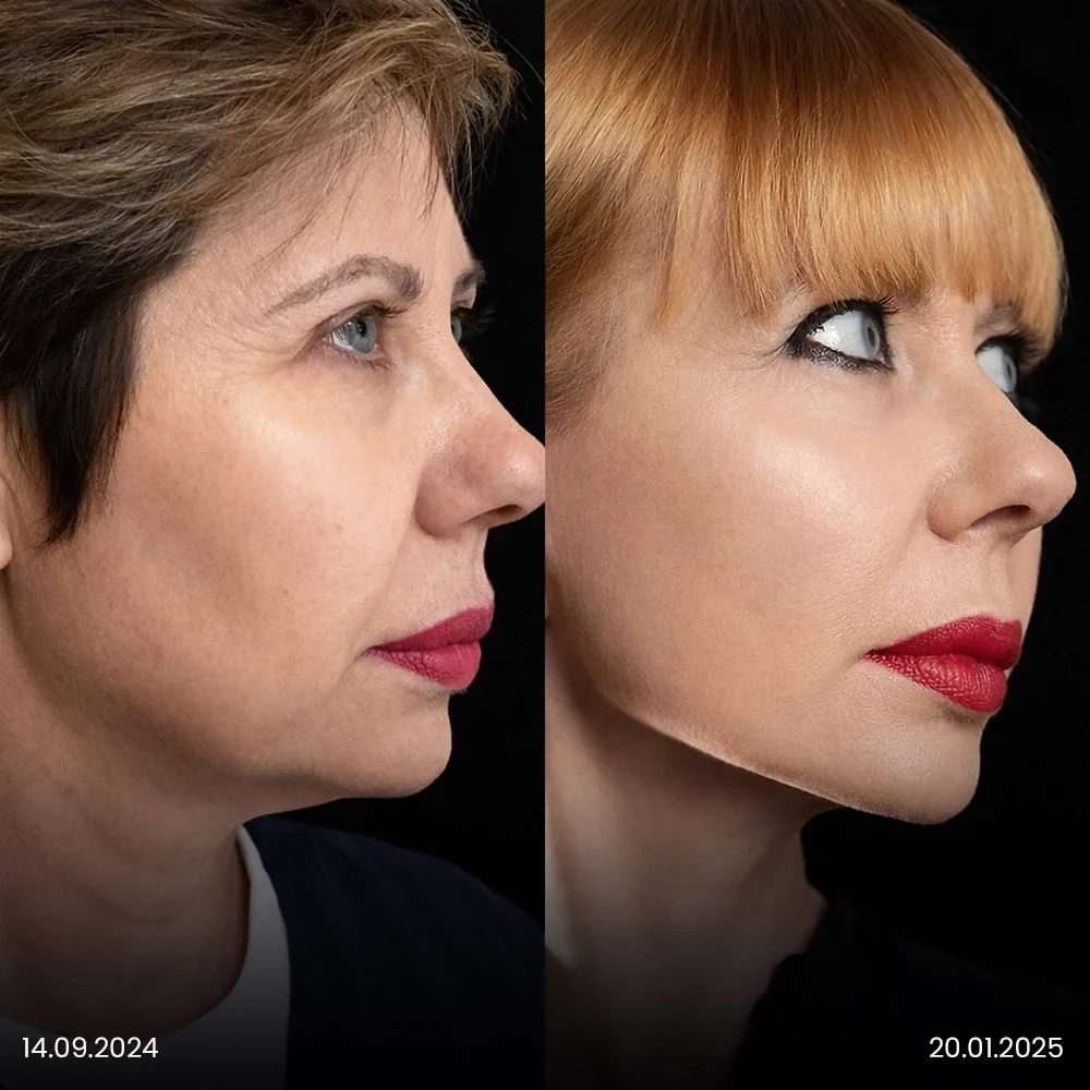Facelift