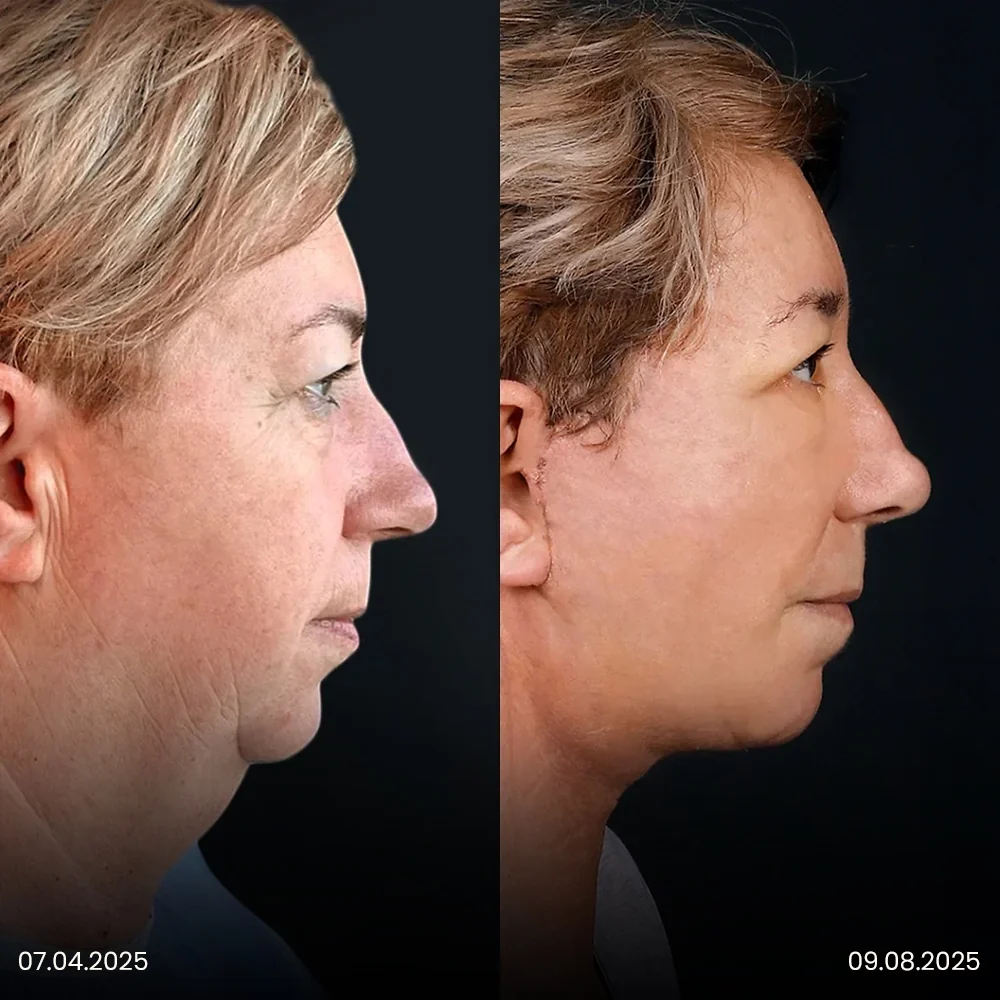 Facelift