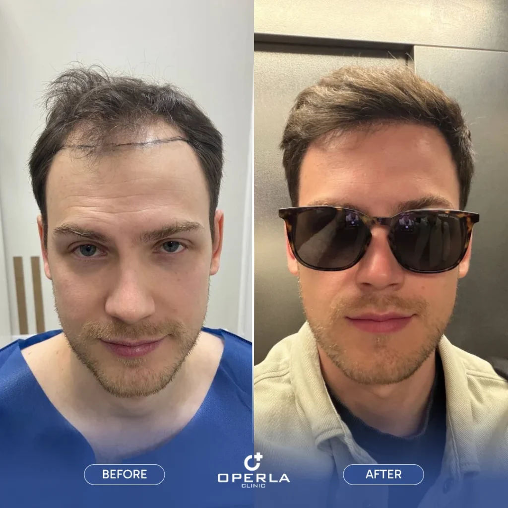 FUE Hair Transplant