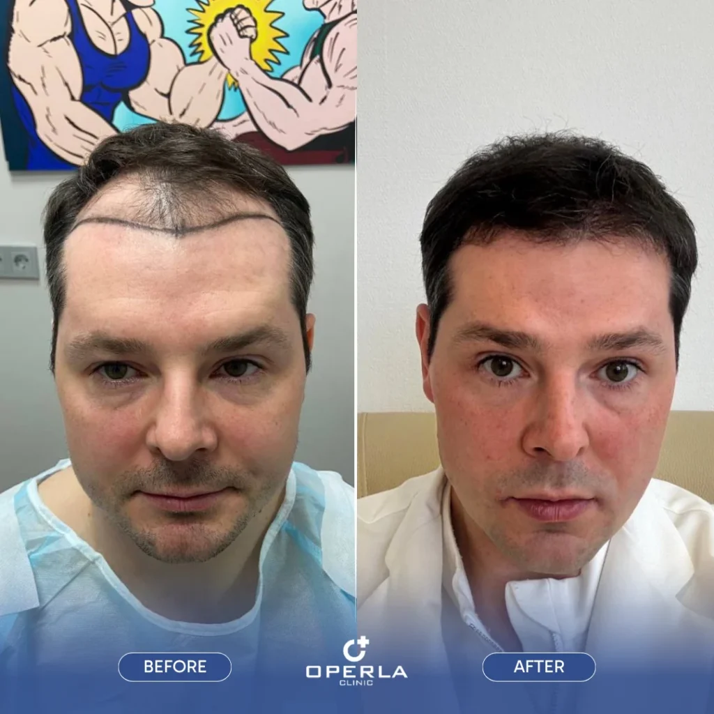 FUE Hair Transplant