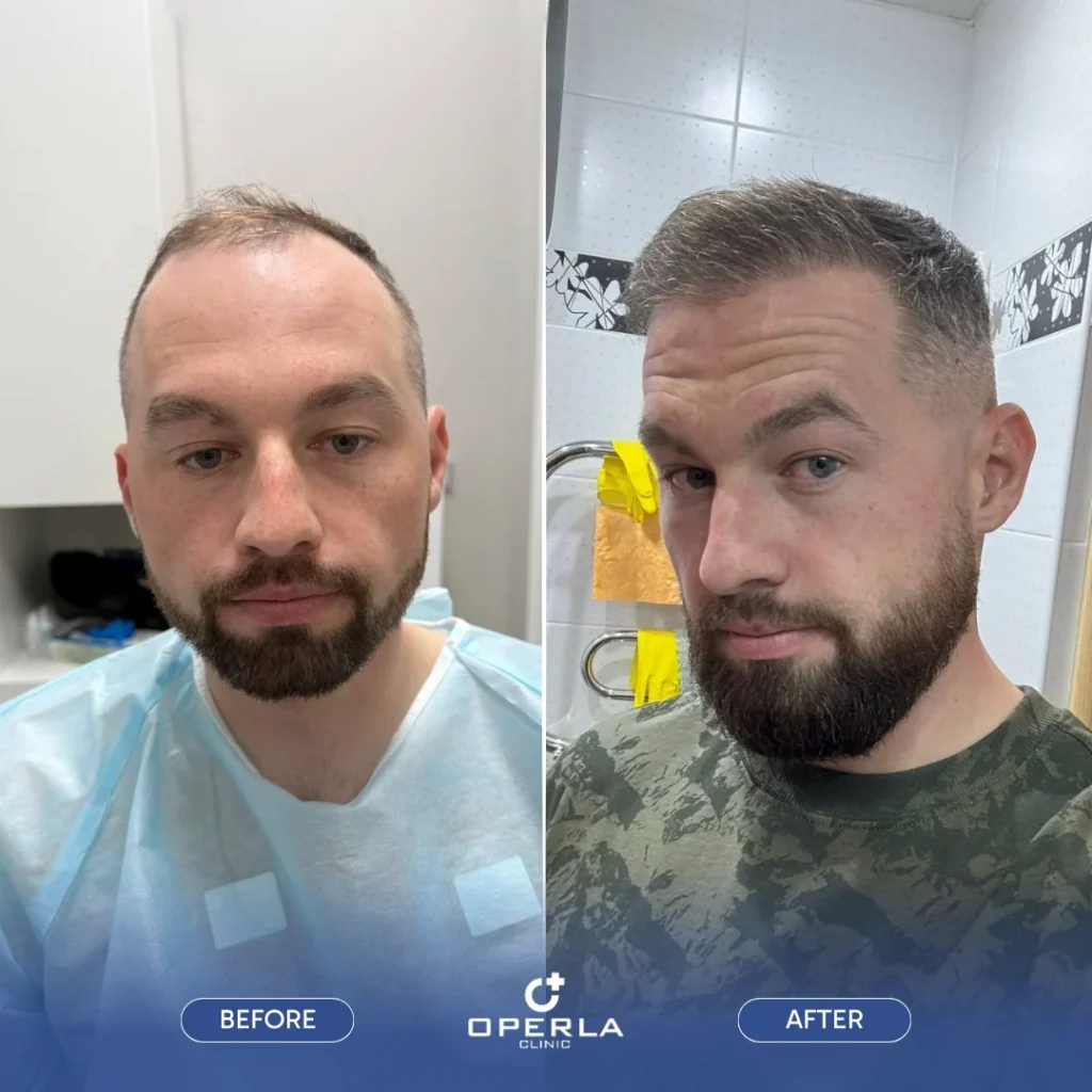 DHI Hair Transplant