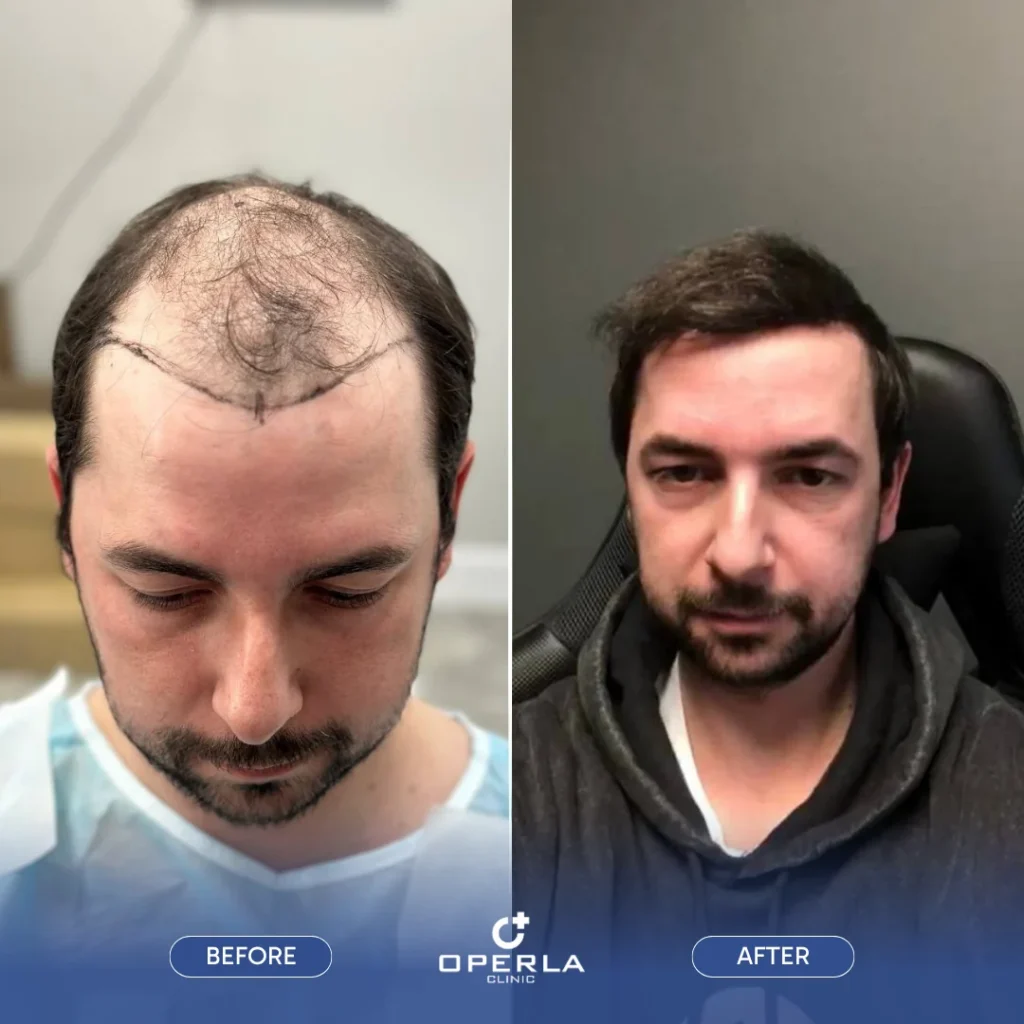DHI Hair Transplant