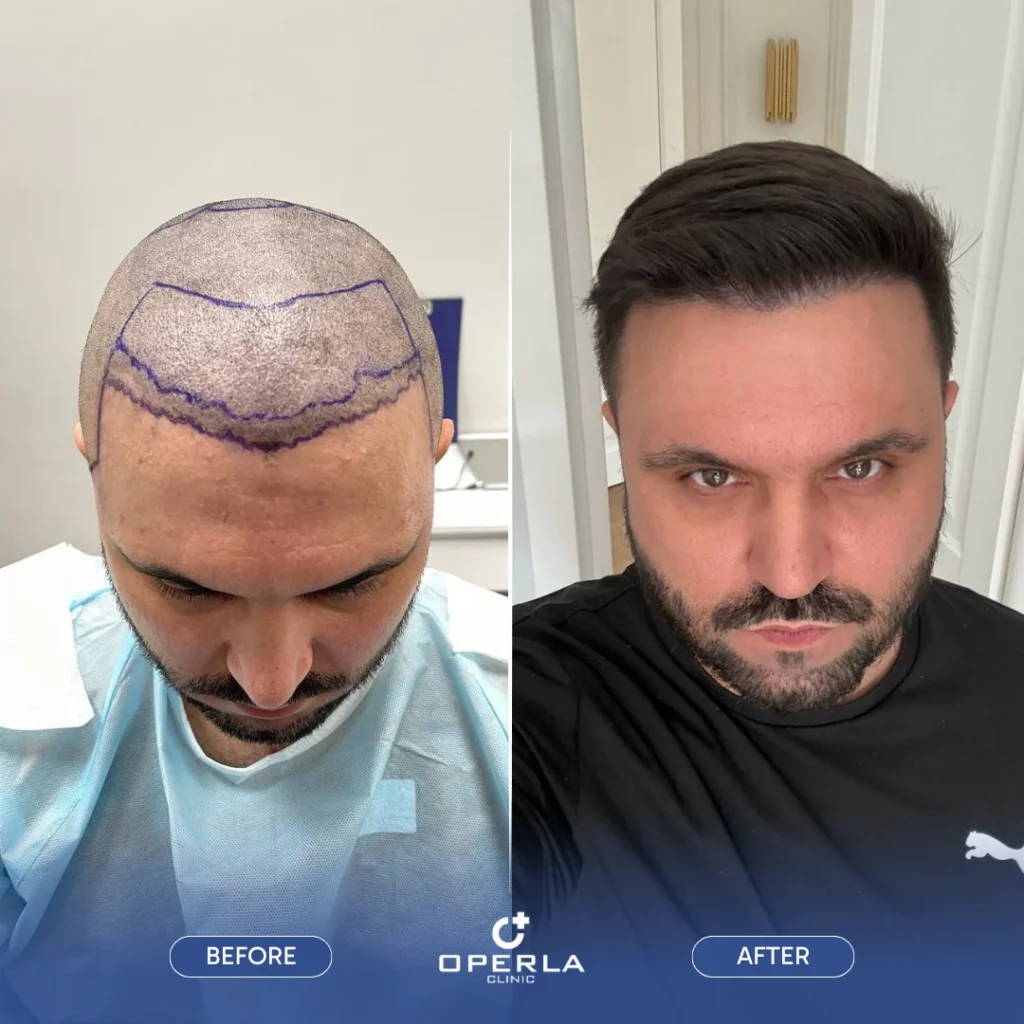 Female Hair Transplant