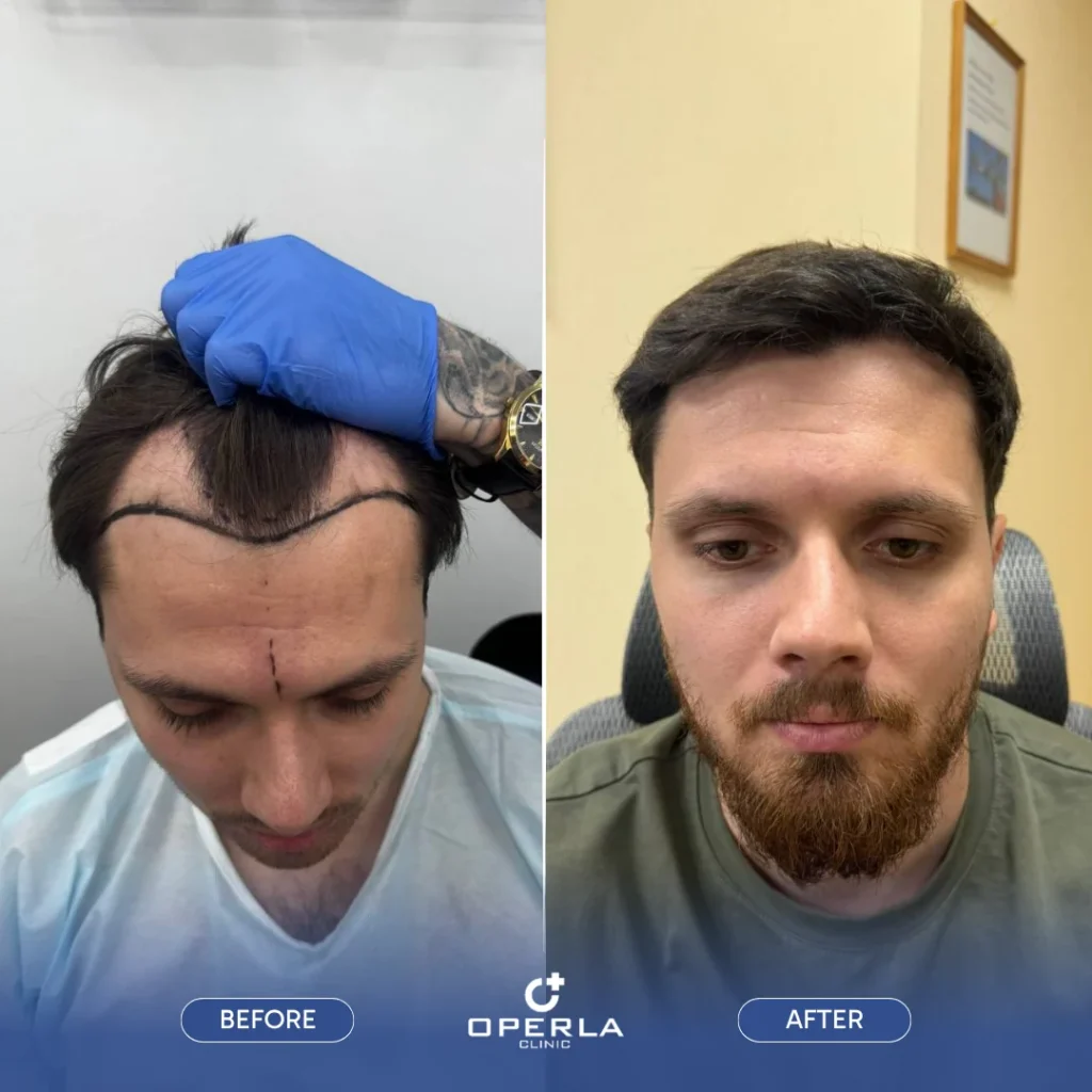 Female Hair Transplant