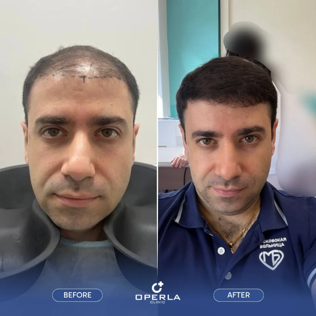 Beard Hair Transplant