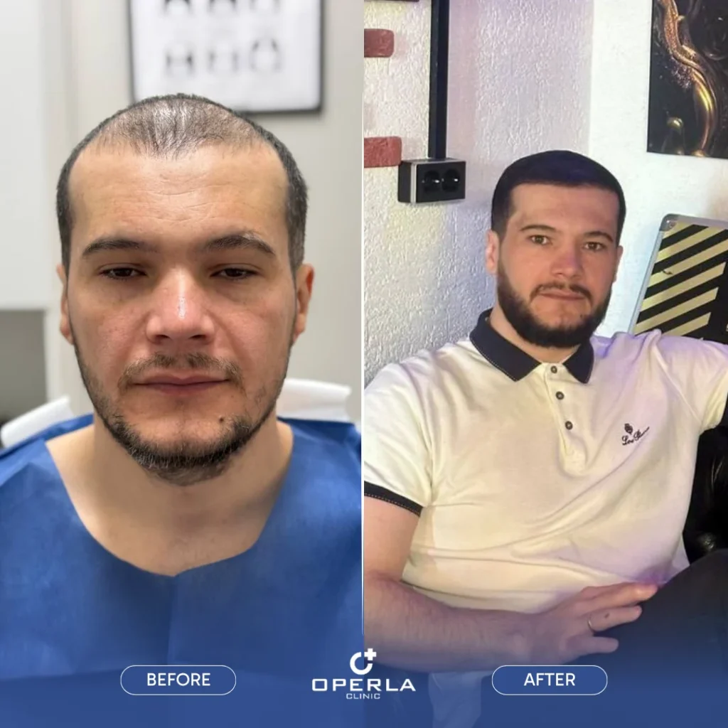 Beard Hair Transplant