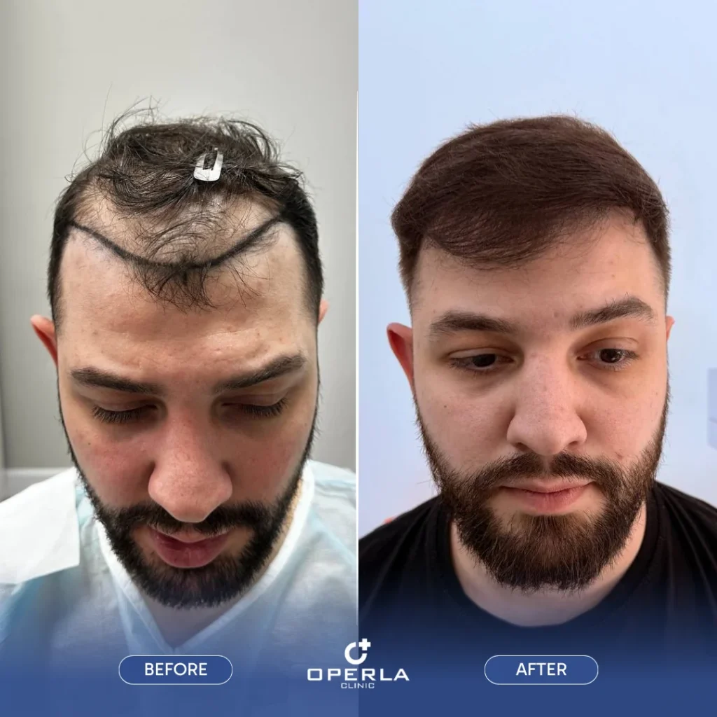 Eyebrow Transplant