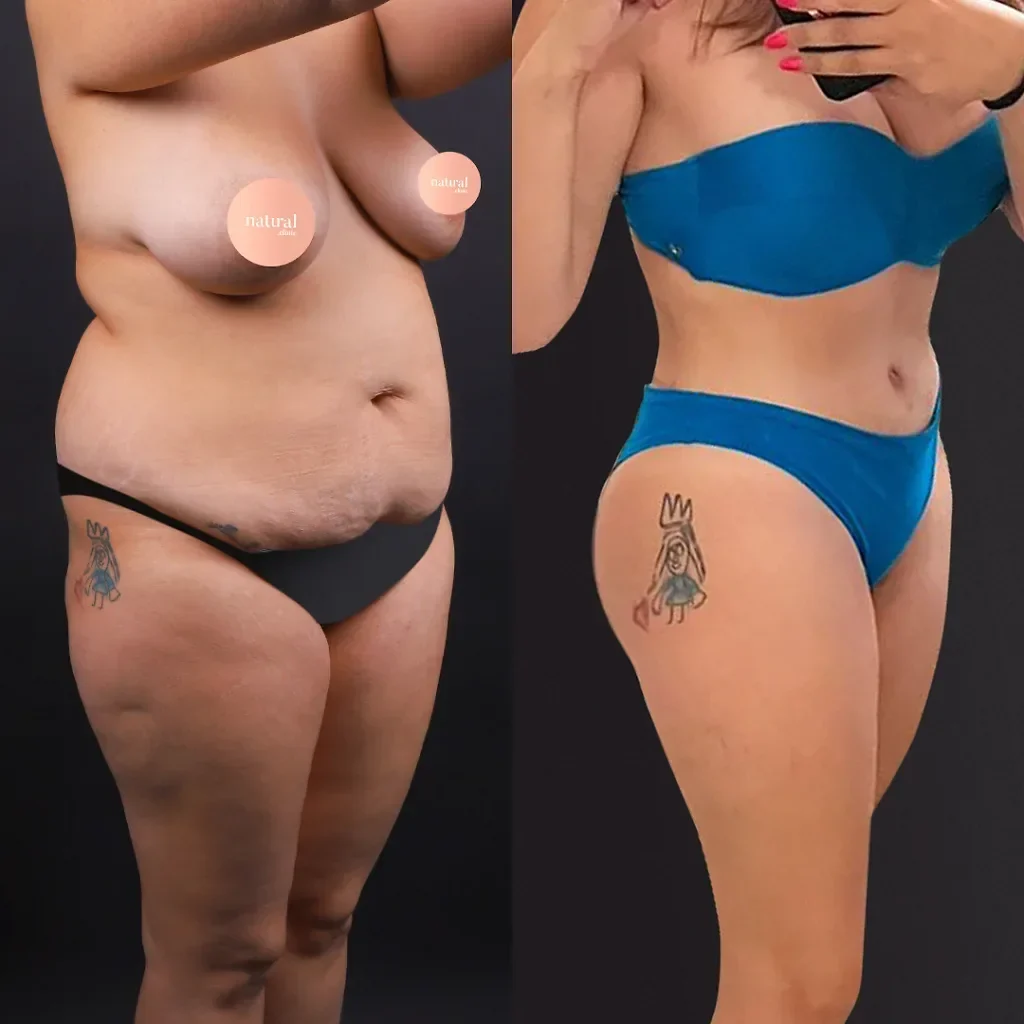 Liposuction