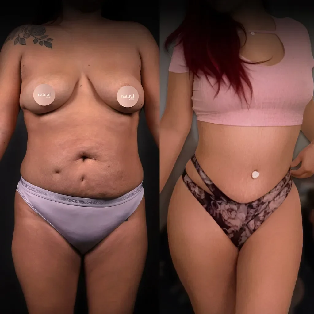 Liposuction