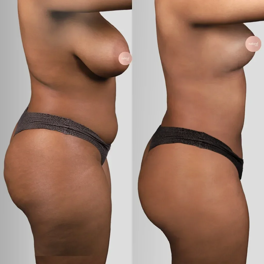 Liposuction