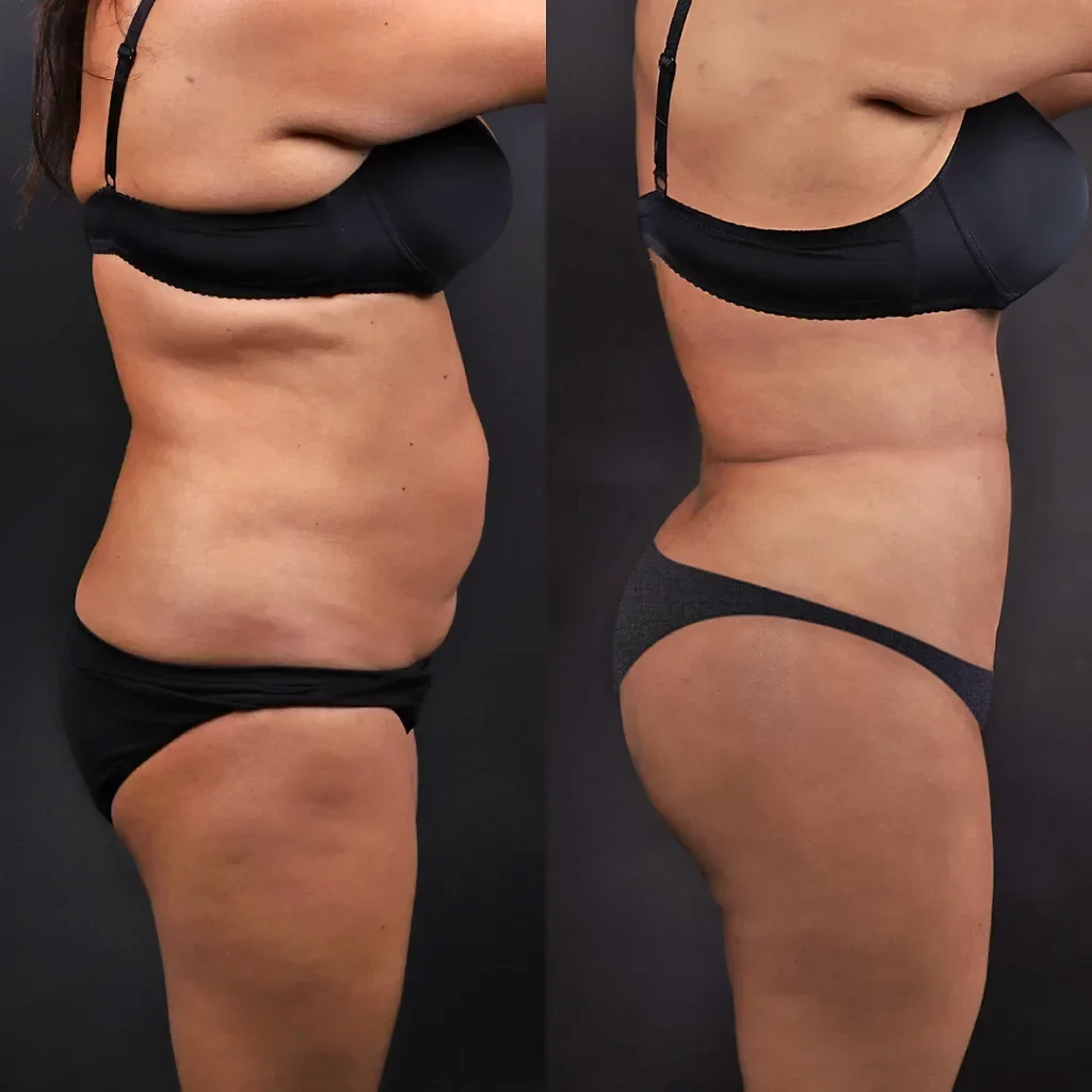 Liposuction