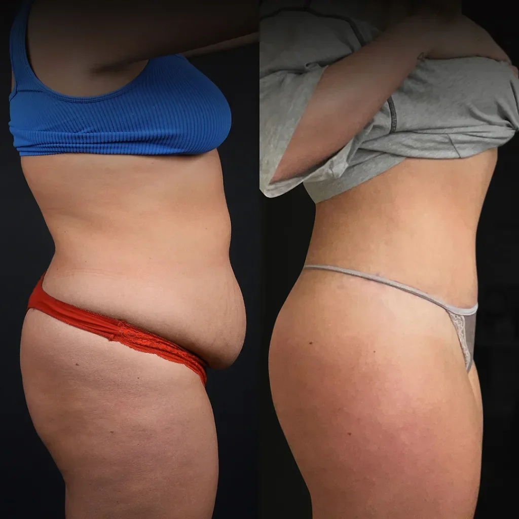 Liposuction