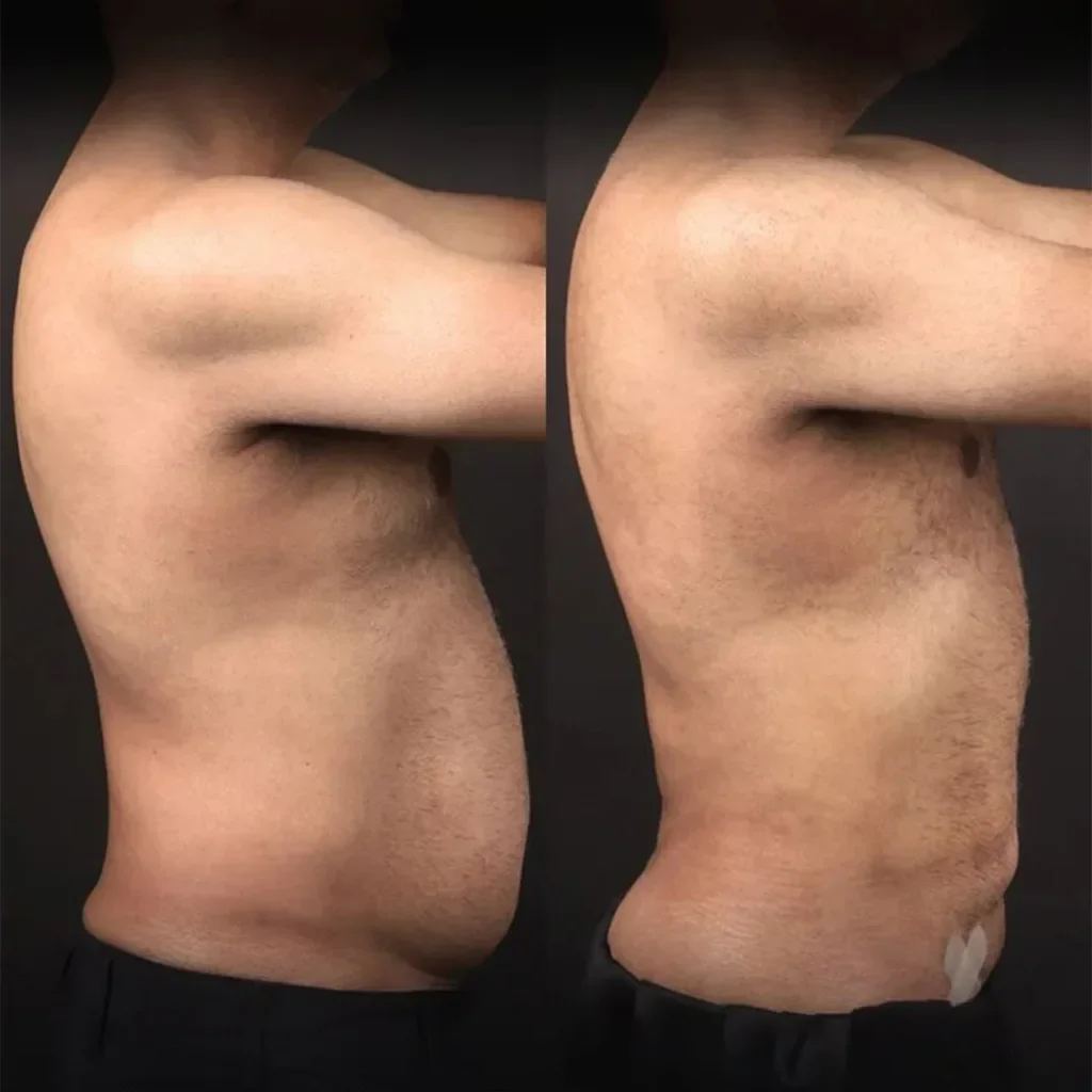 Liposuction