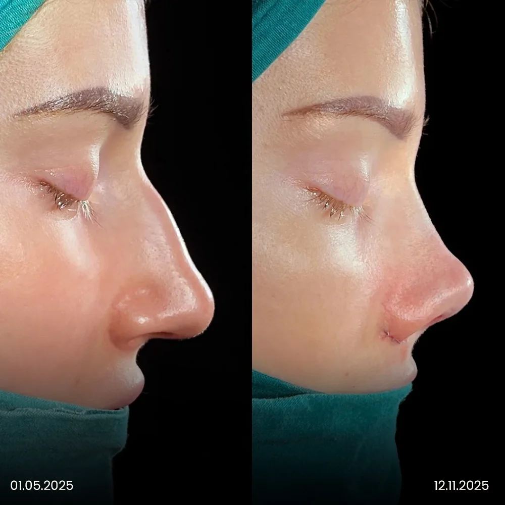 Rhinoplasty