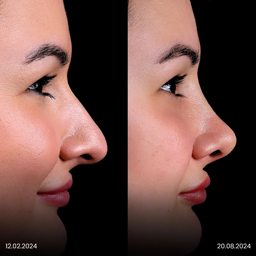 Rhinoplasty