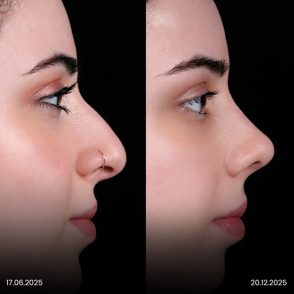 Rhinoplasty