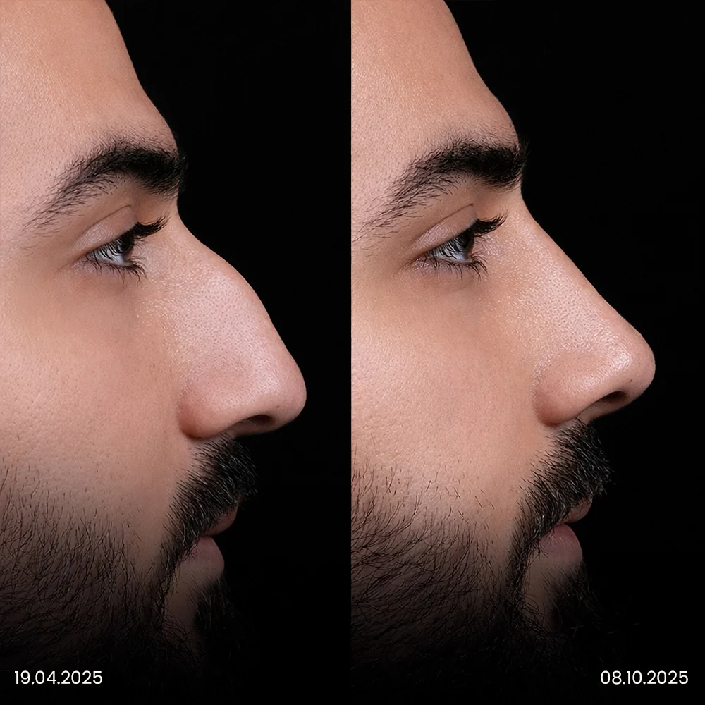 Rhinoplasty