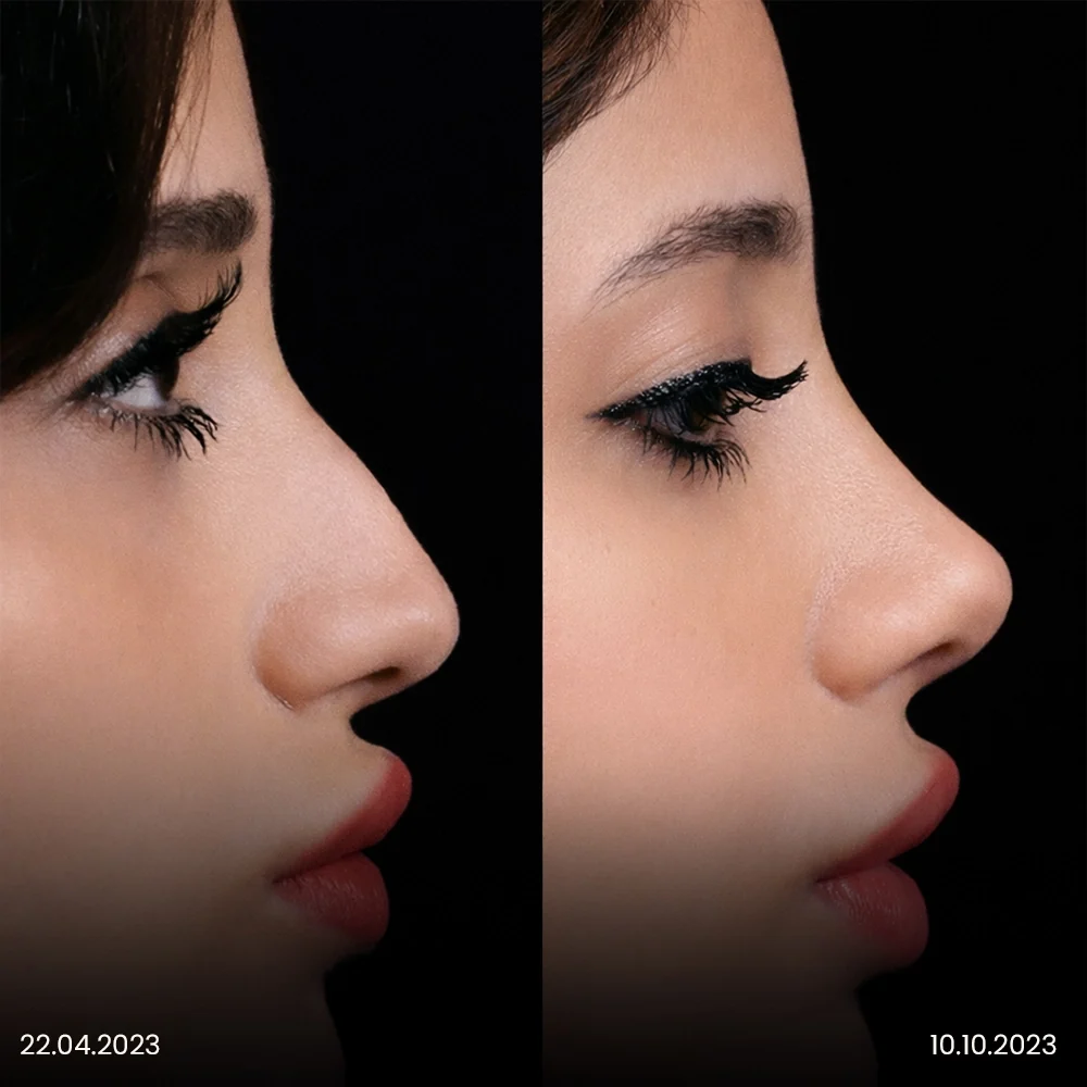 Rhinoplasty