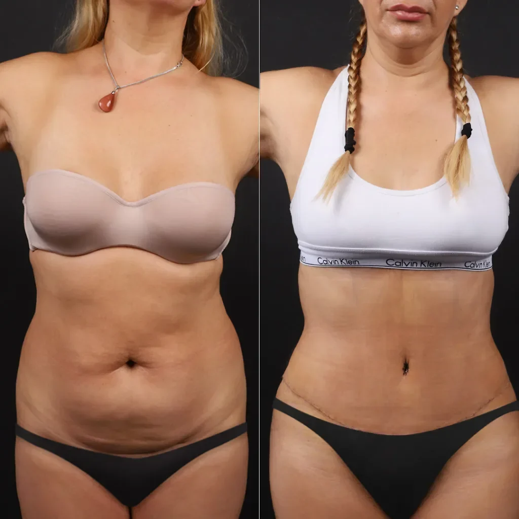 Tummy Tuck (Abdominoplasty)
