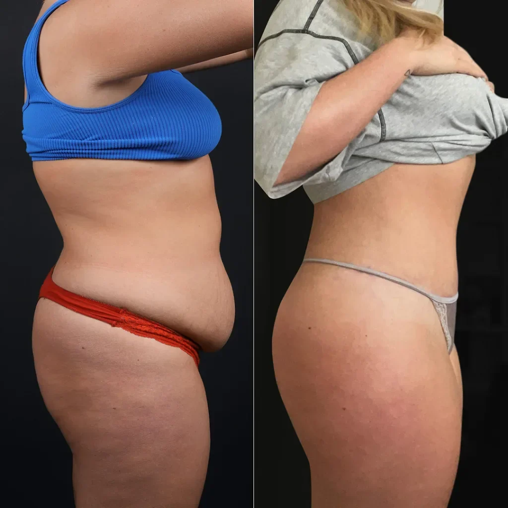 Tummy Tuck (Abdominoplasty)